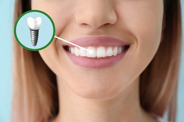 Five Questions To Ask A General Dentist About A Dental Implant Restoration